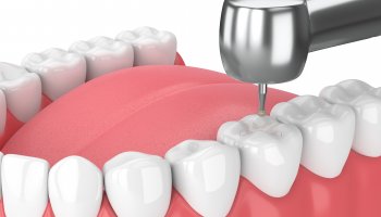 Hampaan paikkaus Cerec keraaminen paikka kruunu hinta Oulu