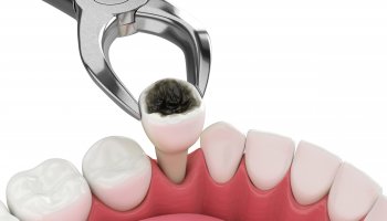 Hampaan poisto puudutus Oulu